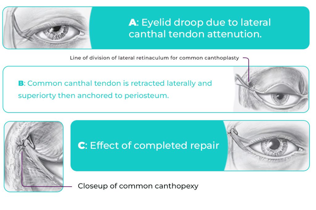 Lateral Canthoplasty or Pulling the Outer Corner of the Eye | Iran Health Agency