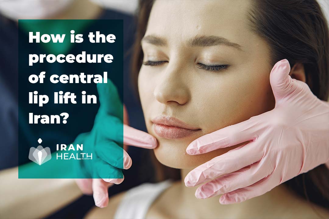 How is the procedure of central lip lift in Iran?