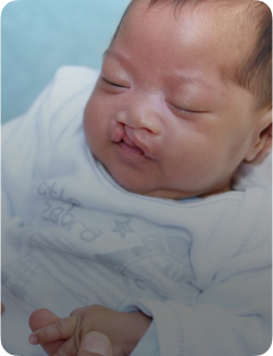 Cleft Lip and Palate Repair Aftercare