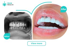 dental veneer in iran before after photos