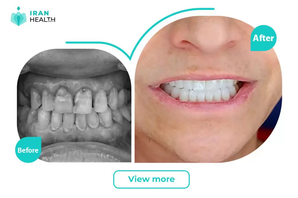 dental veneer in iran before after photos