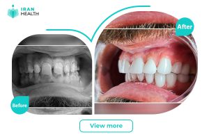dental veneer in iran before after photos