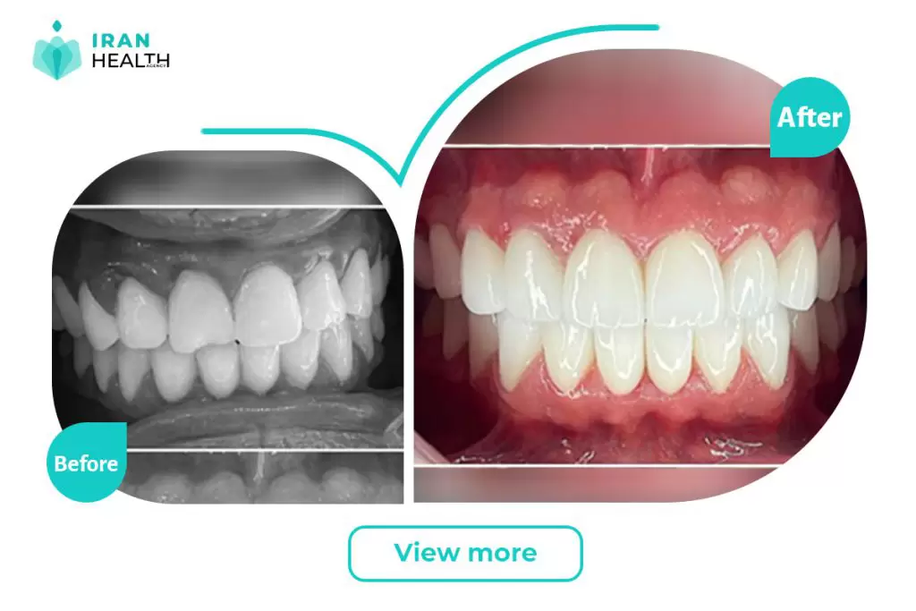 dental veneer in iran before after photos