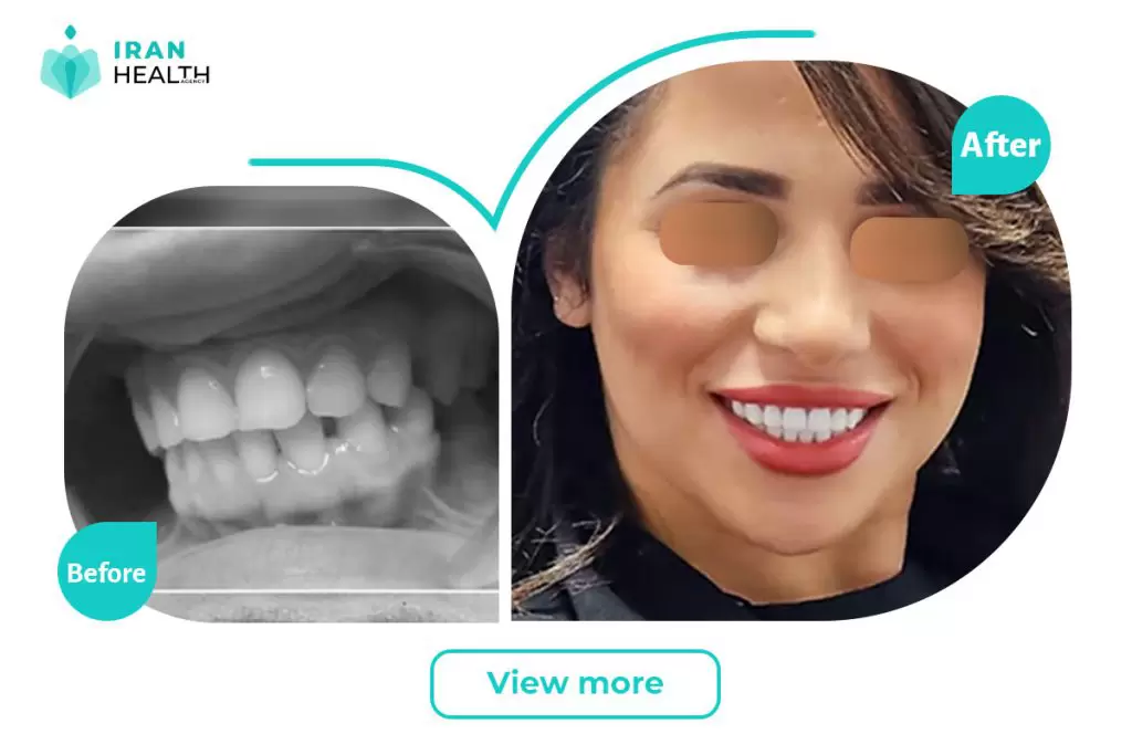 dental veneer in iran before after photos