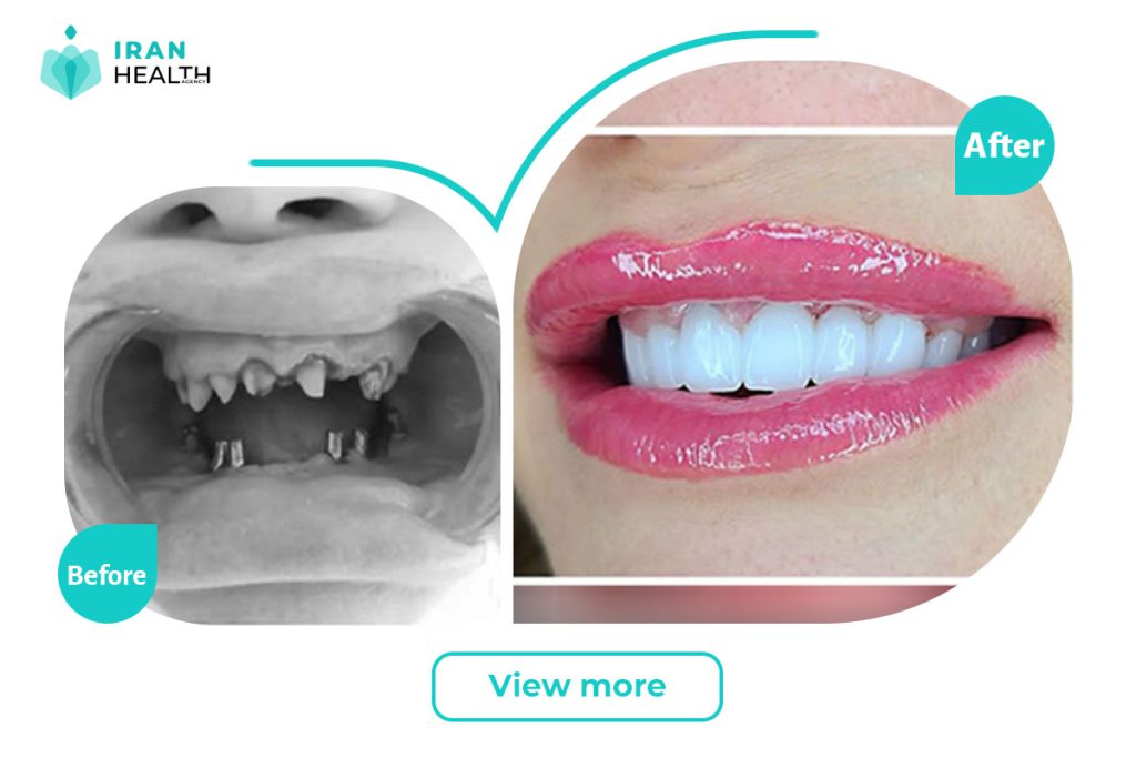 Dental Implant in iran before and after photos