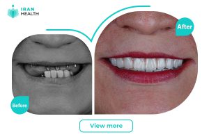 Dental Implant in iran before and after photos