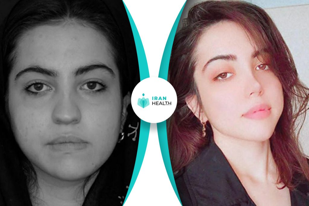 Dr Abbasi rhinoplasty before and after pic (1)
