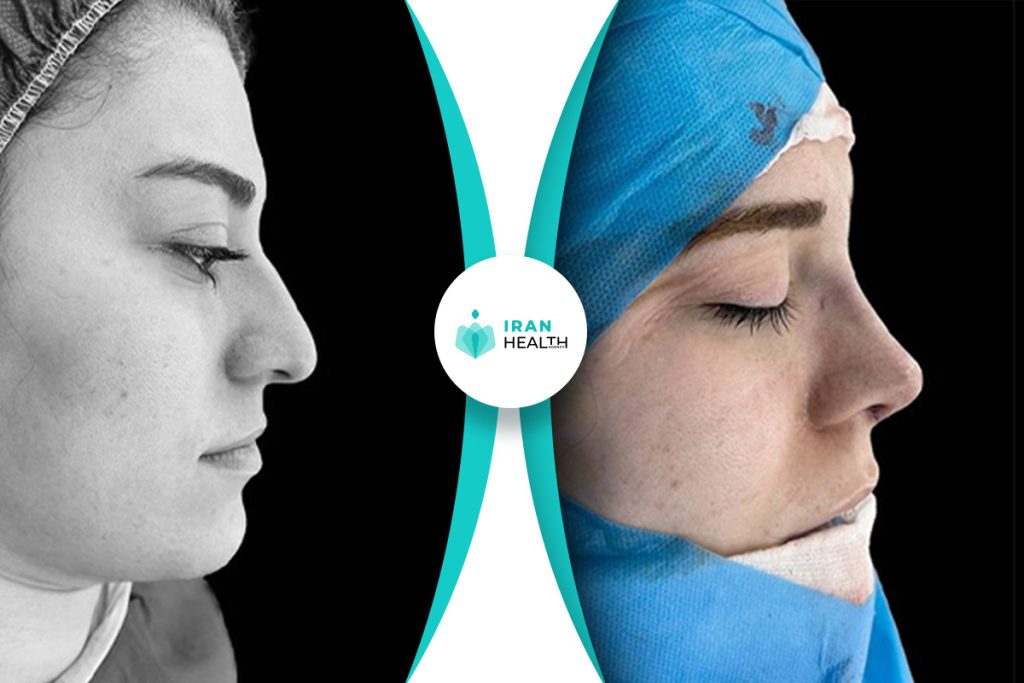 Dr Abbasi rhinoplasty before and after pic (5)
