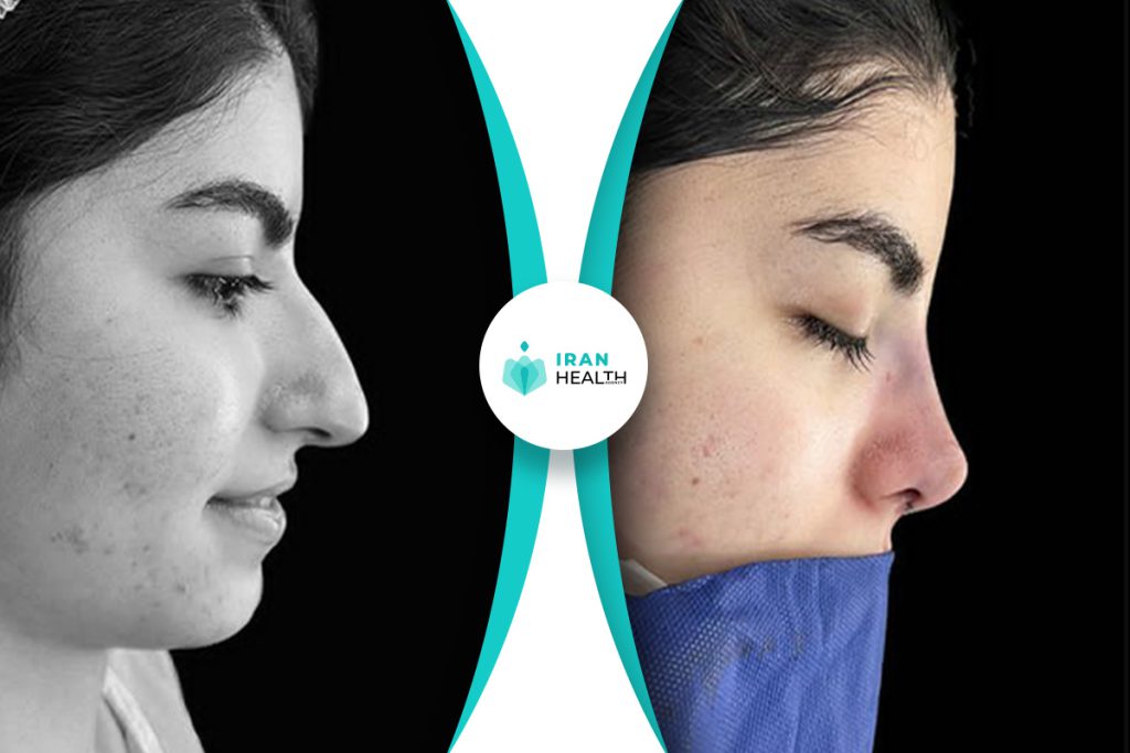 Dr Abbasi rhinoplasty before and after pic (6)