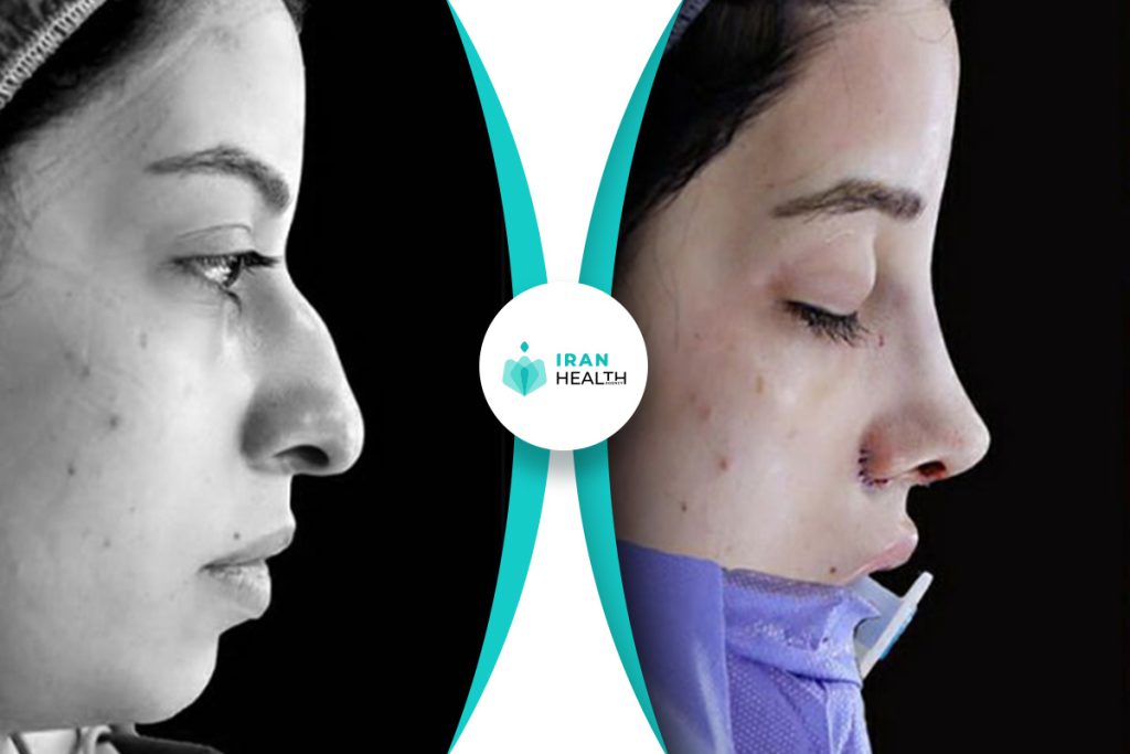 Dr Abbasi rhinoplasty before and after pic (8)