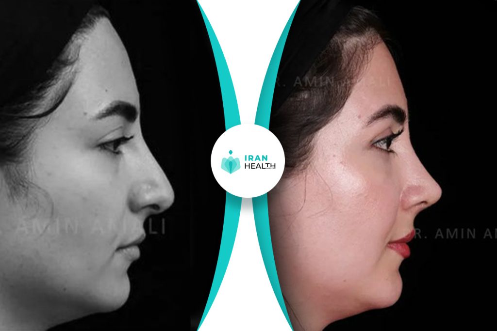 Dr Amali rhinoplasty in iran before and after photos (5)
