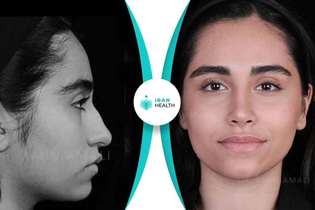 Dr Amali rhinoplasty in iran before and after photos (5)