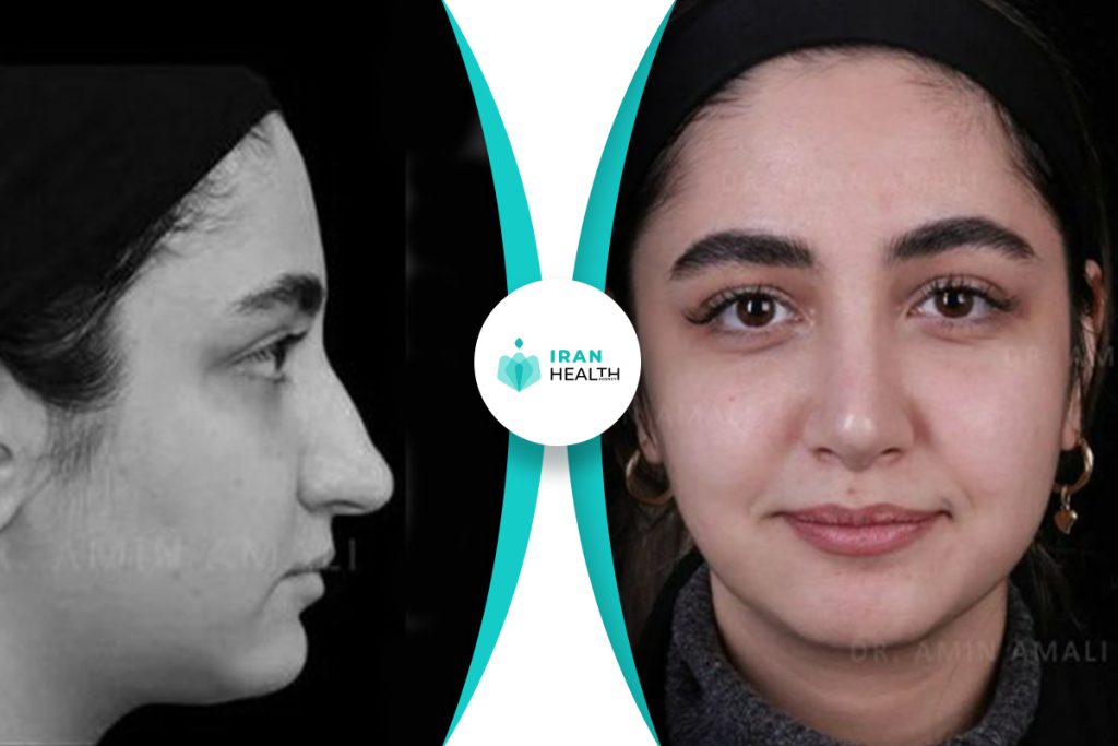 Dr Amali rhinoplasty in iran before and after photos (1)