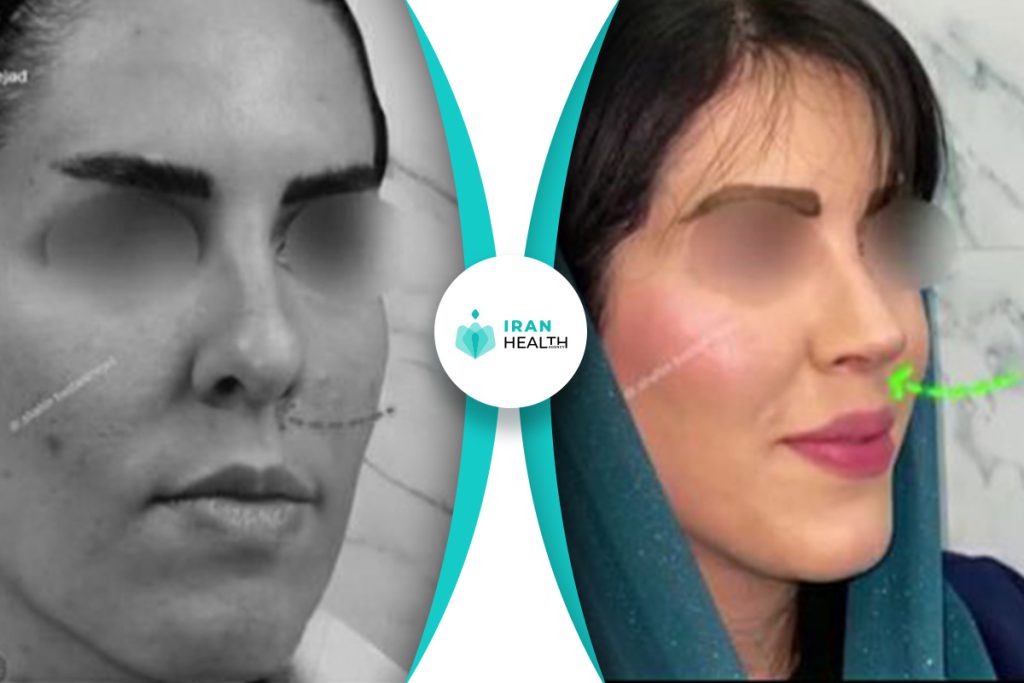 Dr Bastan nejad rhinoplasty in iran before after photos