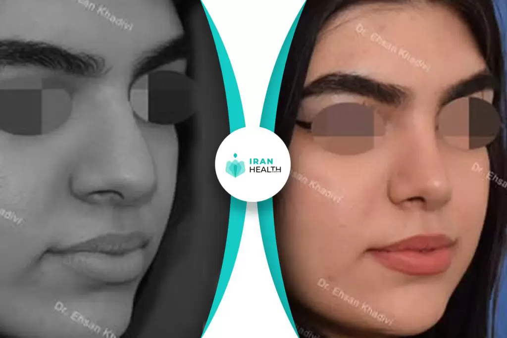 Dr Khadavi rhinoplasty in iran before and after photos