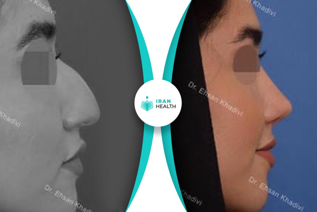 Dr Khadavi rhinoplasty in iran before and after photos