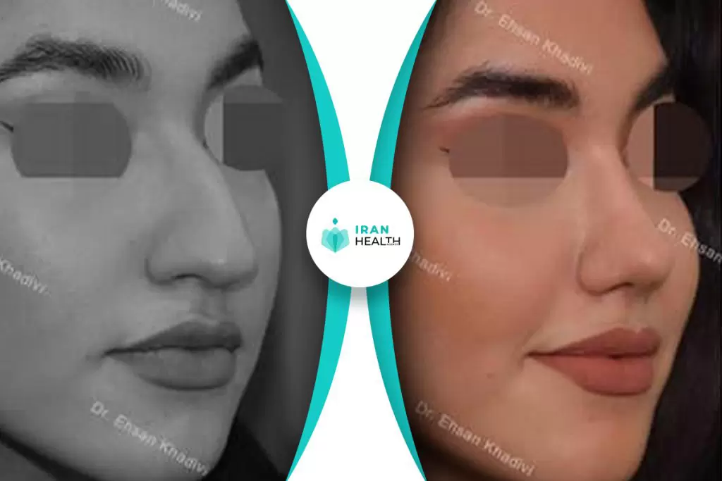 Dr Khadavi rhinoplasty in iran before and after photos