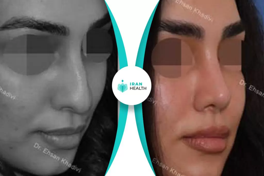 Dr Khadavi rhinoplasty in iran before and after photos