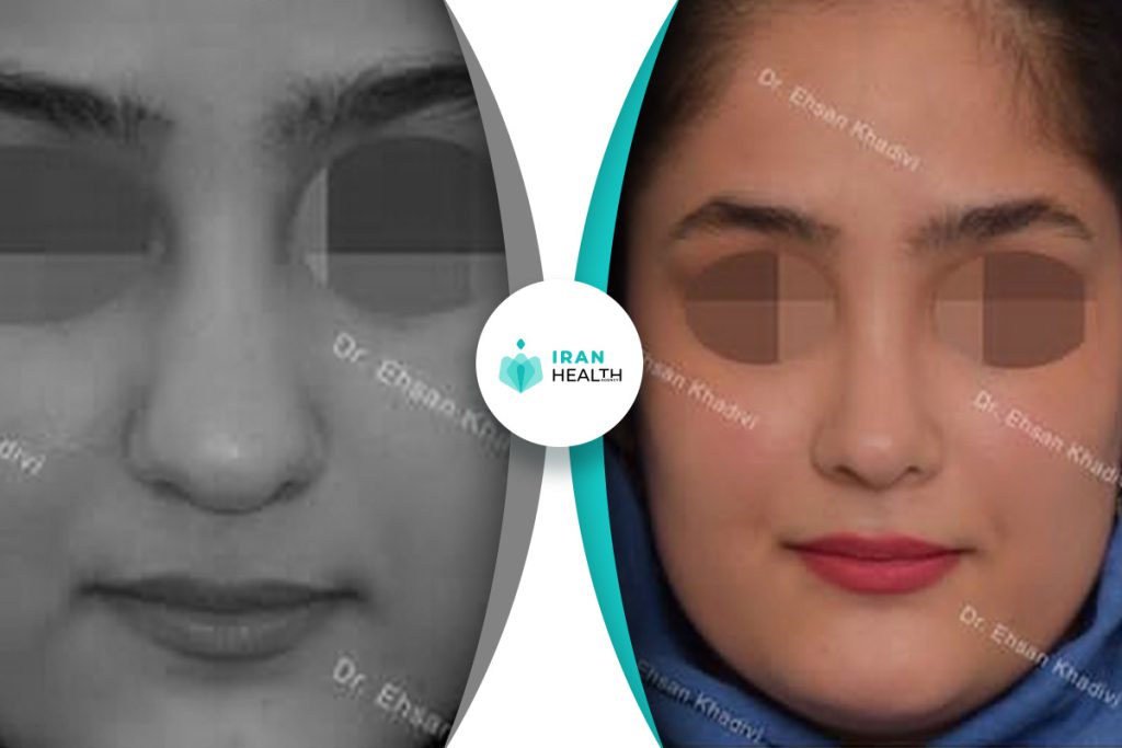 Dr Khadavi rhinoplasty in iran before and after photos