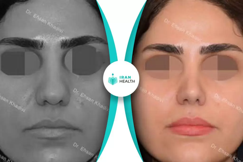 Dr Khadavi rhinoplasty in iran before and after photos