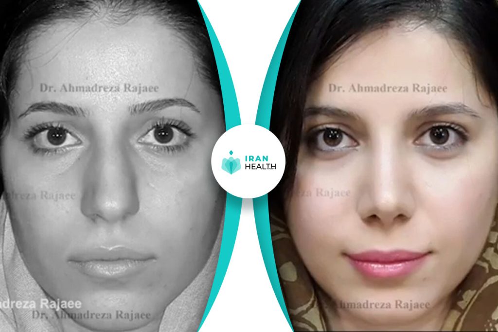 Dr Rajaeee before after nose job (2)