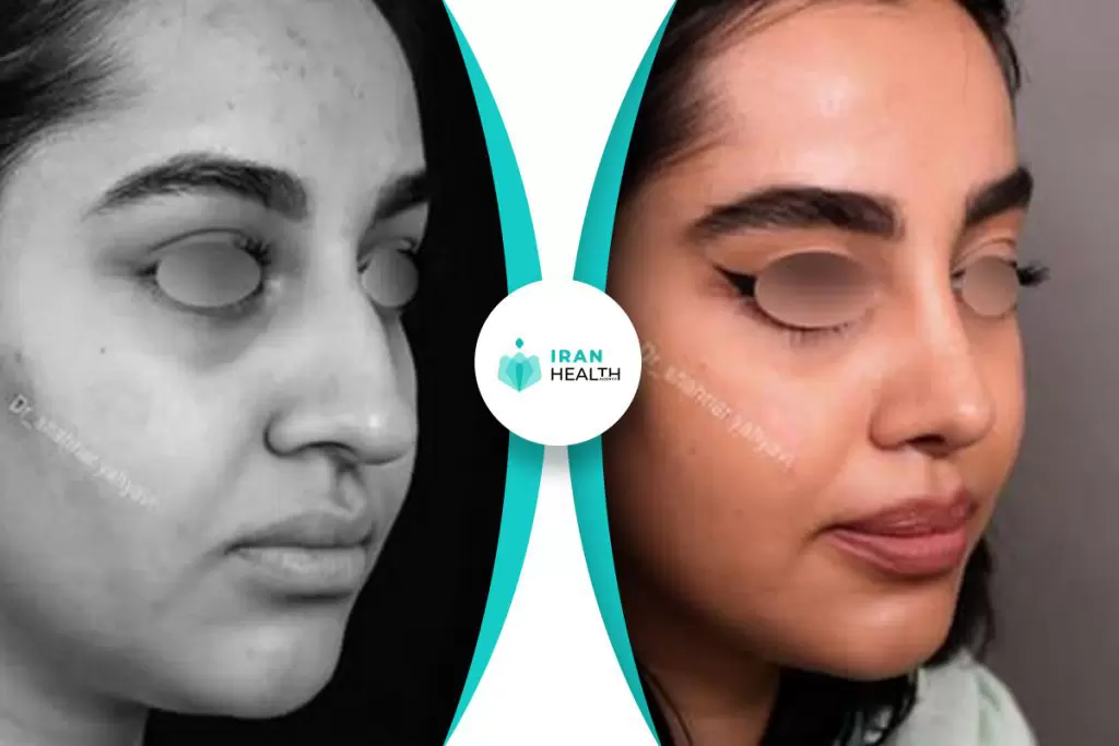 Dr Yahyavi rhinoplasty before after pic (1)