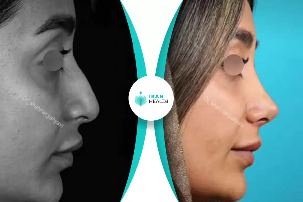 Dr Yahyavi rhinoplasty before after pic (2)