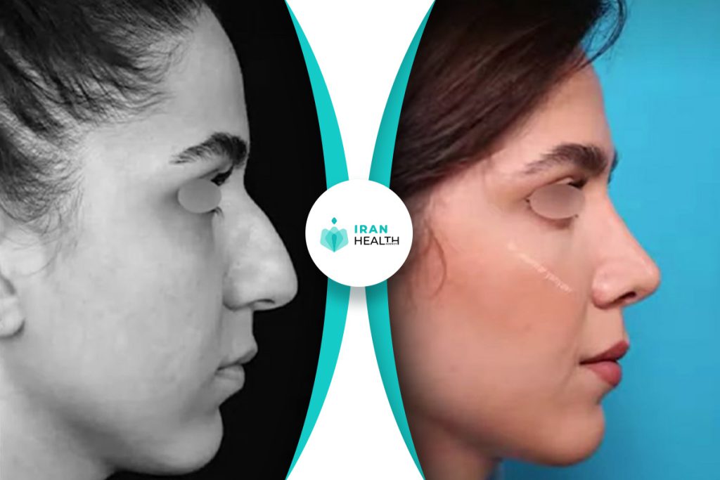 Dr Yahyavi rhinoplasty before after pic (3)