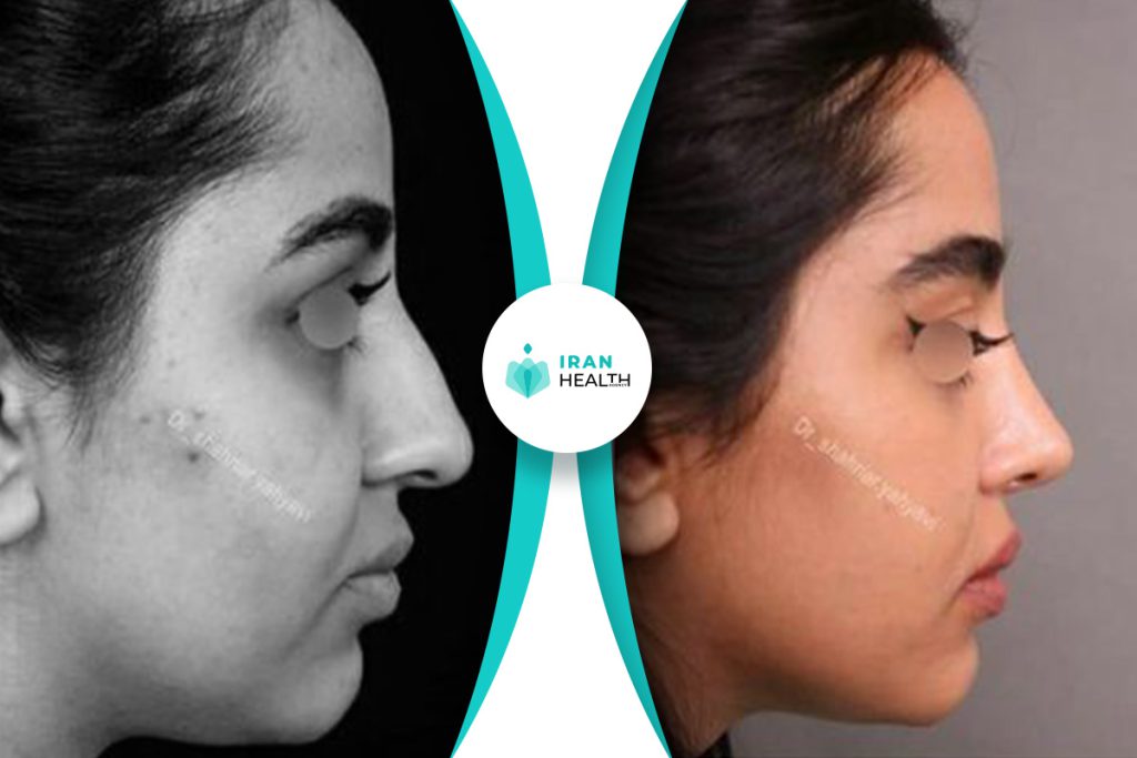 Dr Yahyavi rhinoplasty before after pic (6)