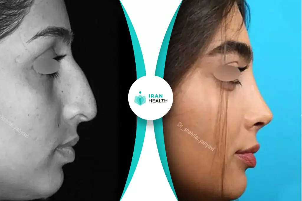 Dr Yahyavi rhinoplasty before after pic (7)