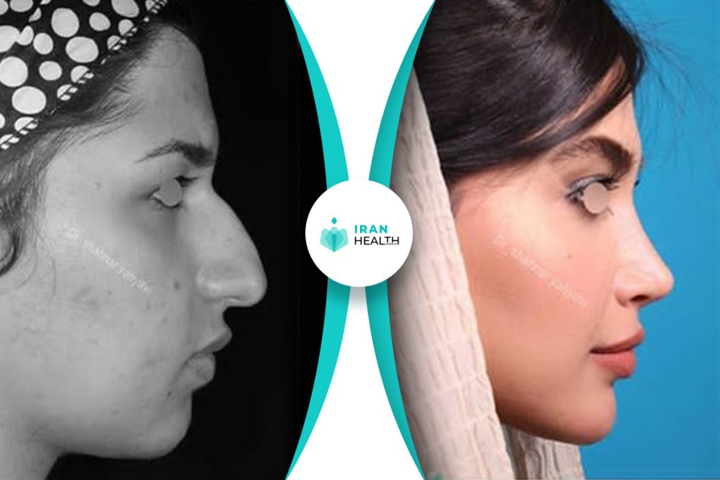 Dr Yahyavi rhinoplasty before after pic (1)