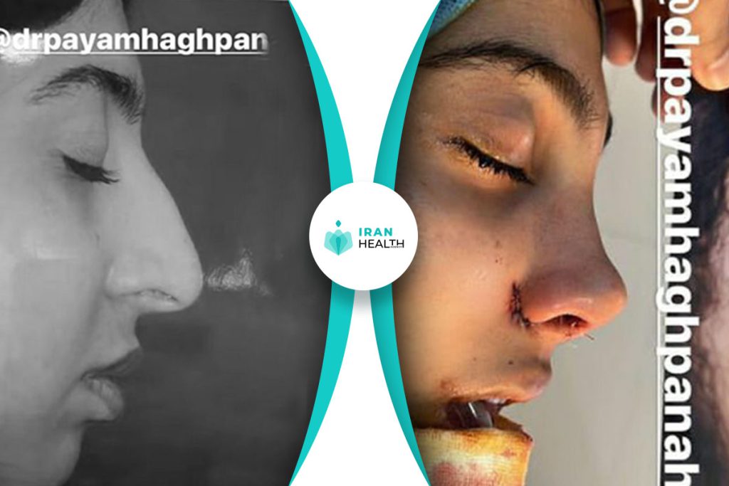 Dr haghpanah rhinoplasty before after (8)
