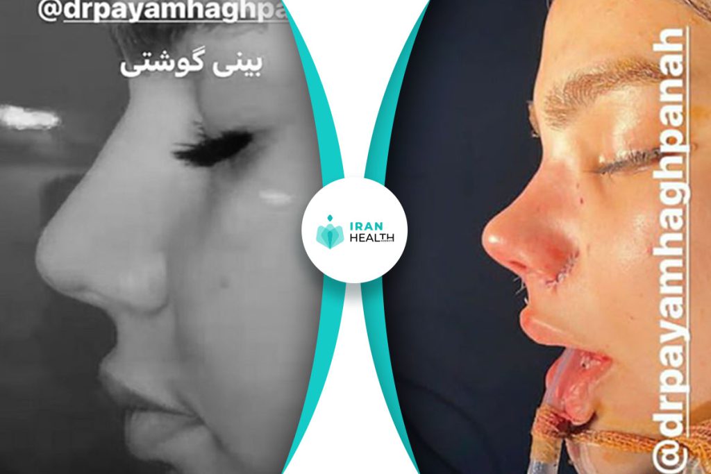 Dr haghpanah rhinoplasty before after (8)
