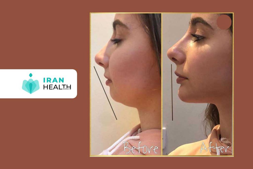 Chin Implant for Round Face