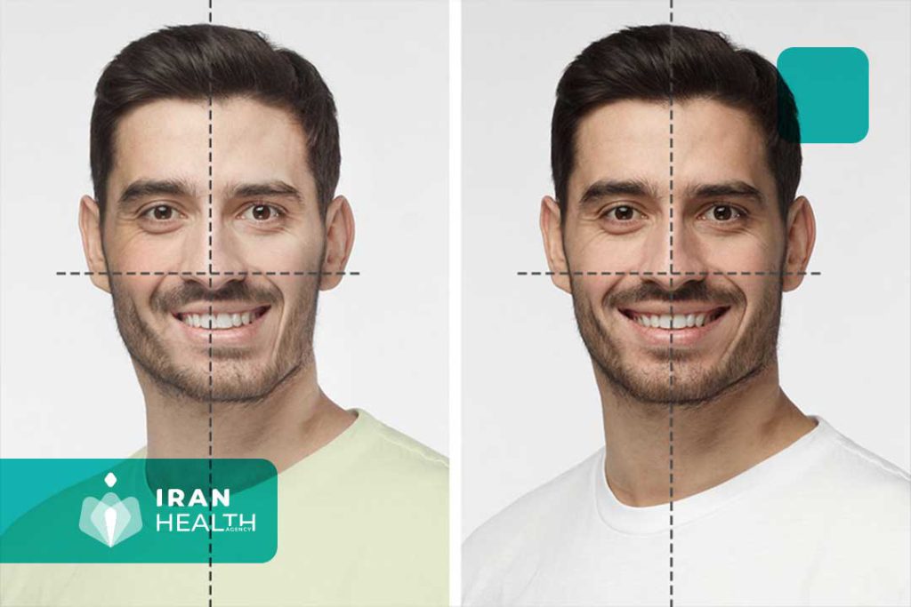 Chin Implant for Asymmetry
