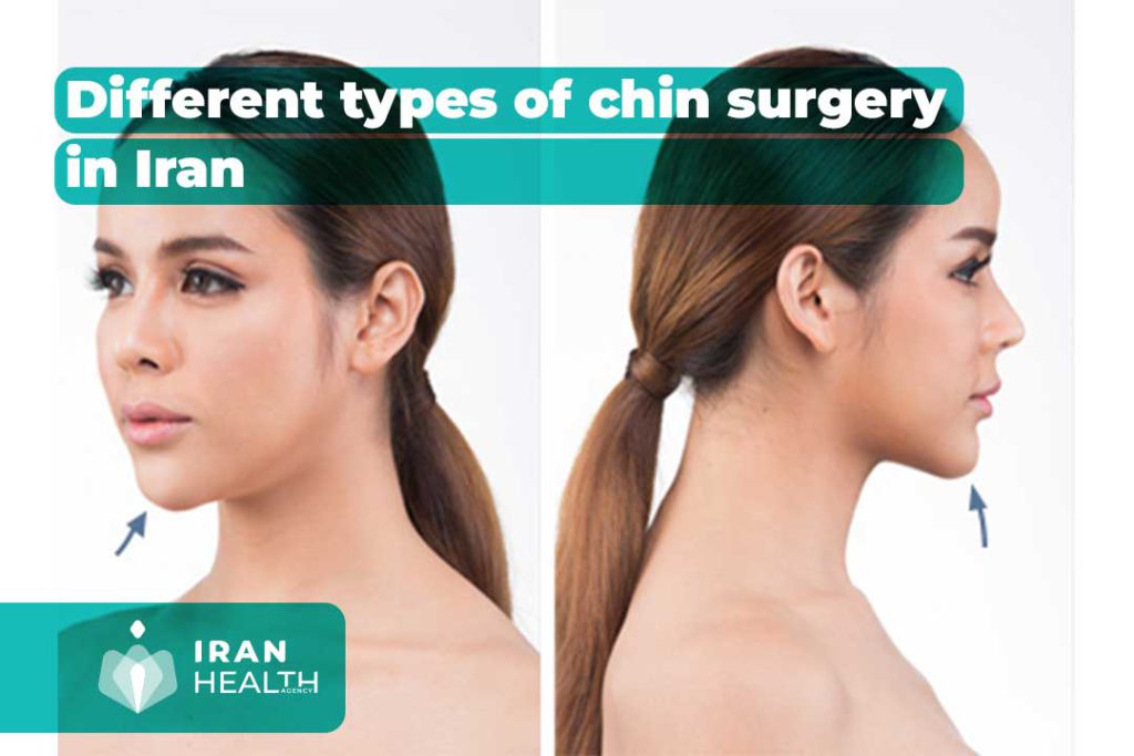 Different types of chin surgery in Iran (AUGMENTATION & REDUCTION)