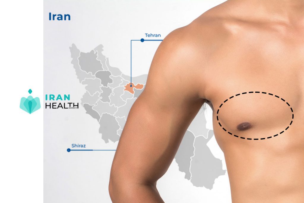 What are the treatment methods for gynecomastia?
