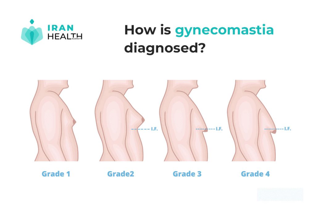 How is gynecomastia diagnosed?