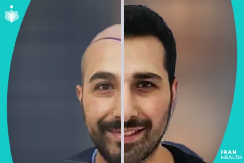 Better Outcome of Hair Transplant in Iran | IRANHEALTHAGENCY