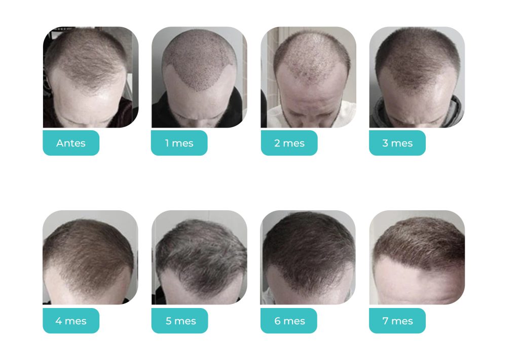 What are the Medical Follow up After the Hair Transplantation in Iran? | IRANHEALTHAGENCY
