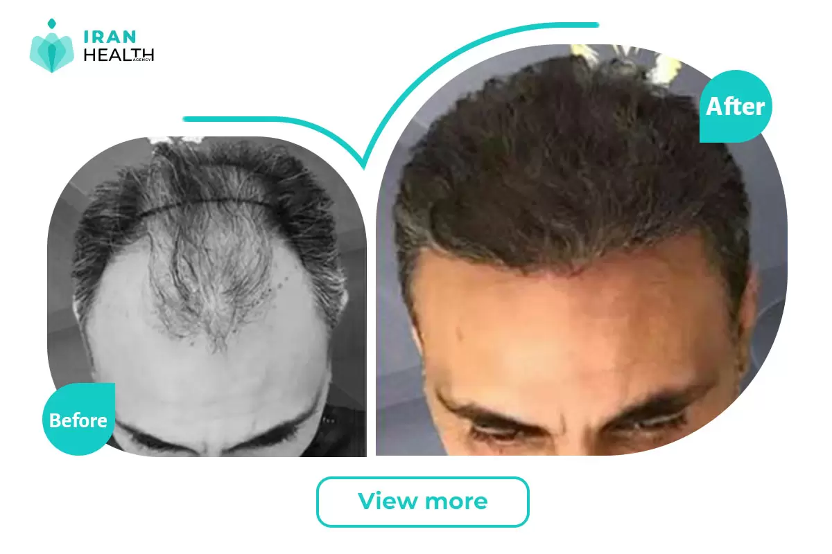Hair Transplant in iran before and after