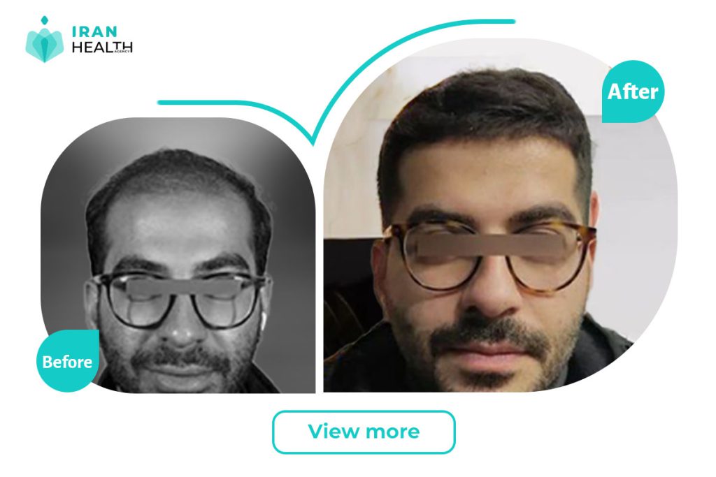 Hair Transplant in iran before and after
