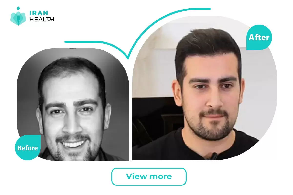 Hair Transplant in iran before and after