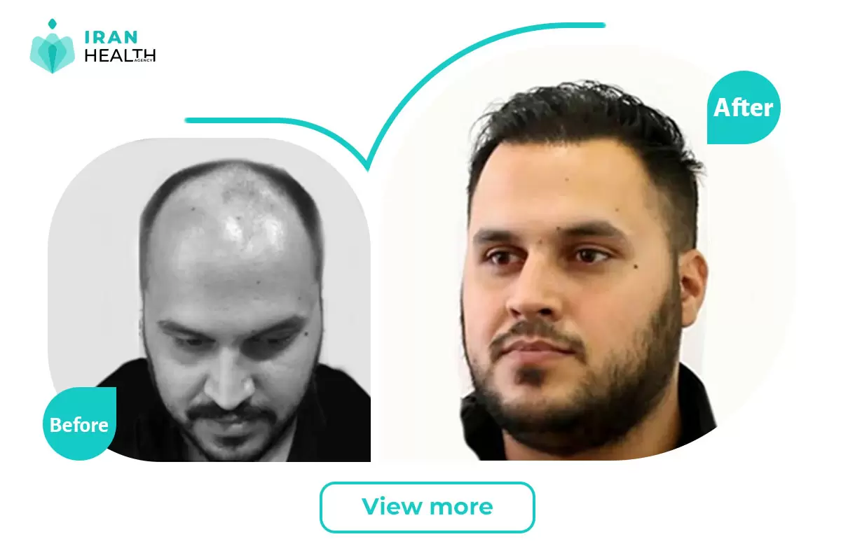 Hair Transplant before and after