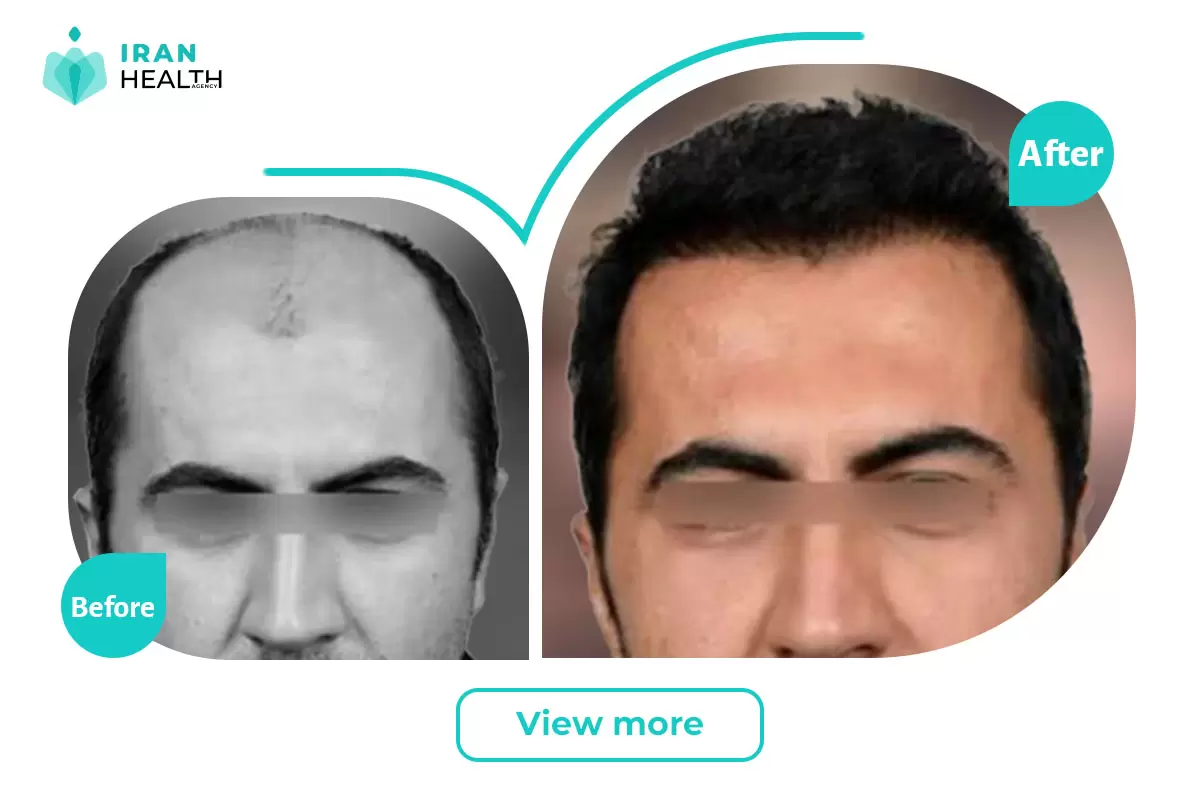 Hair Transplant in iran before and after
