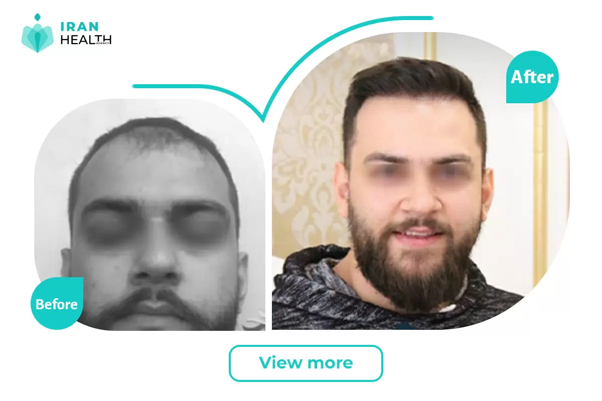 Hair Transplant in iran before and after