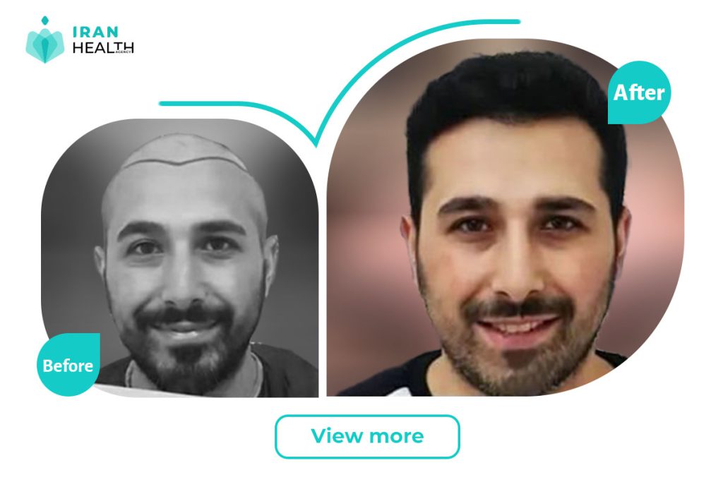 Hair Transplant before and after