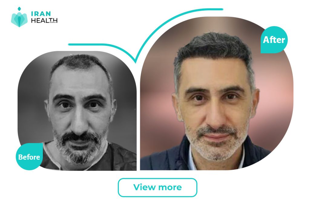 Hair Transplant in iran before and after
