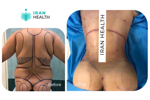 liposuction before after photo