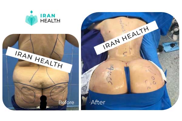 liposuction before after photo